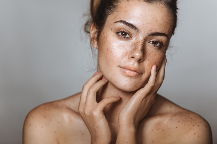 Difference Between Freckles And Blemishes, Possible Treatment