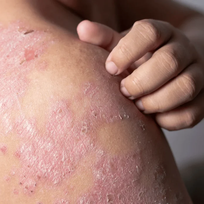 eczema on shoulder